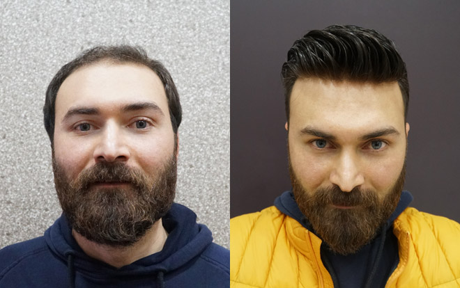 Erkek Protez Sac New Hair New Hair